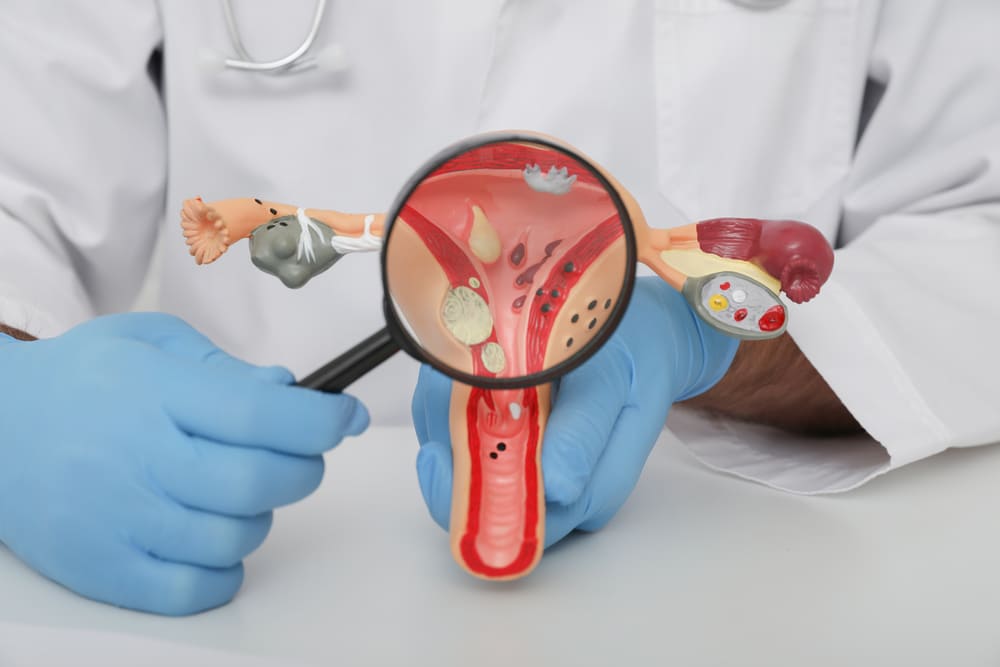 endometriosis