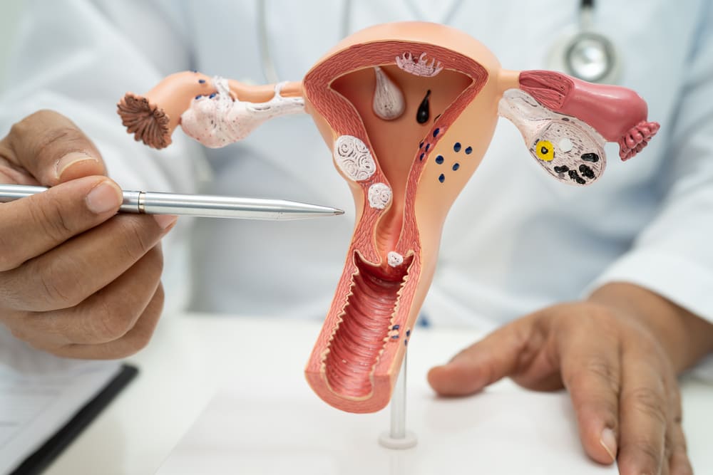 endometriosis
