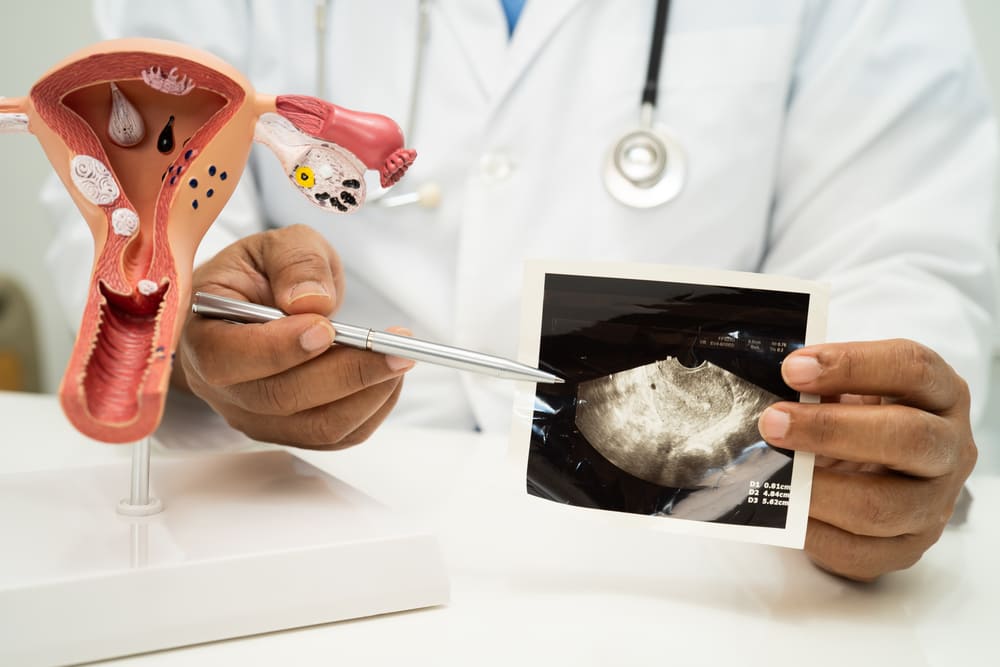 endometriosis