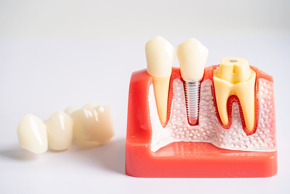 implantes dentales