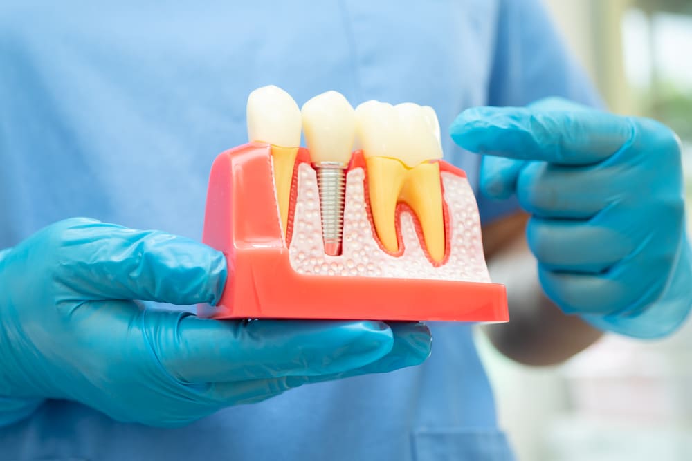 implantes dentales