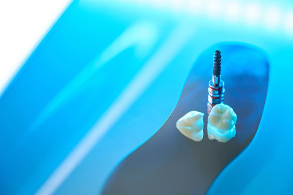implantes dentales en Costa del Este, Panamá