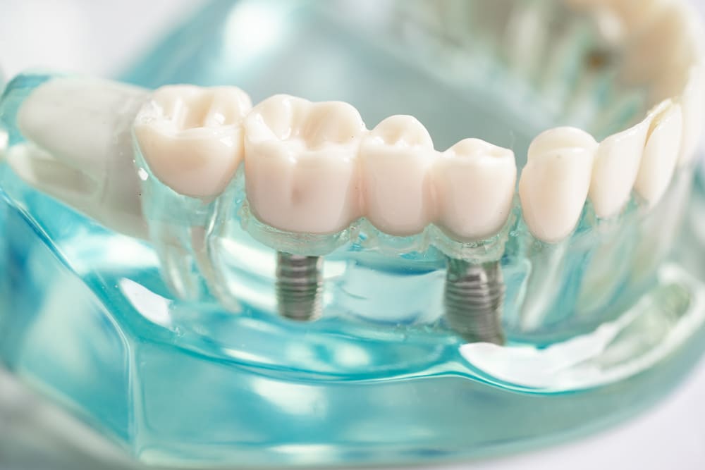 implantes dentales en Costa del Este, Panamá