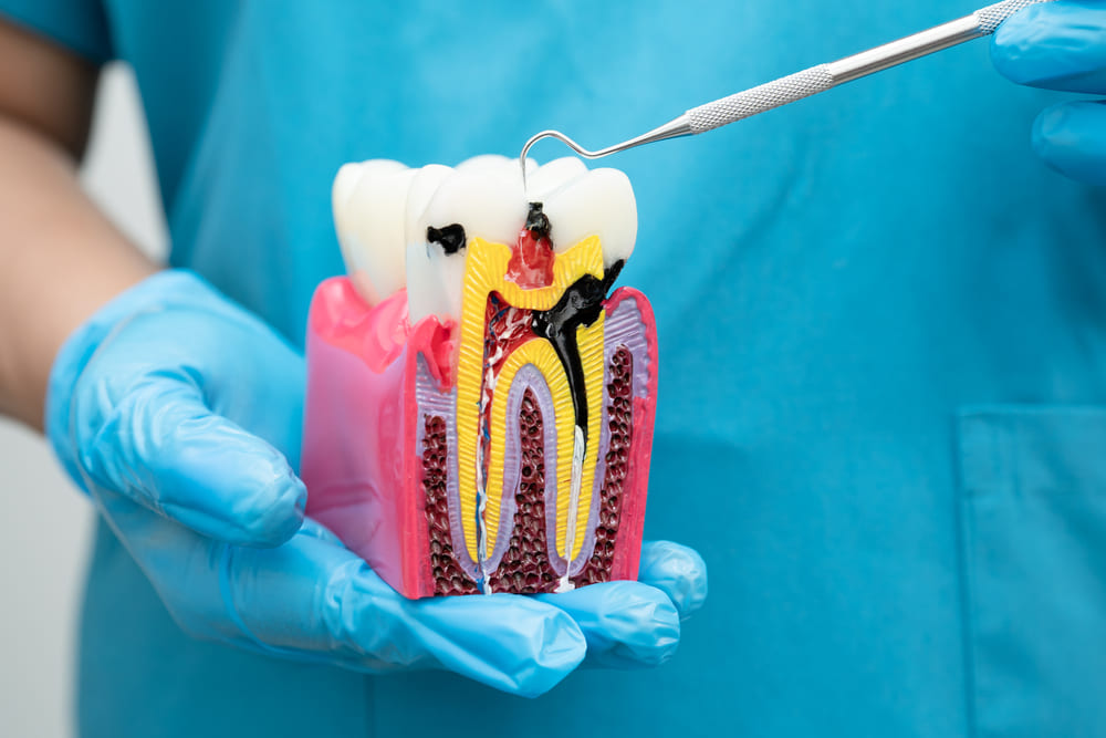 especialistas en endodoncia en Panamá