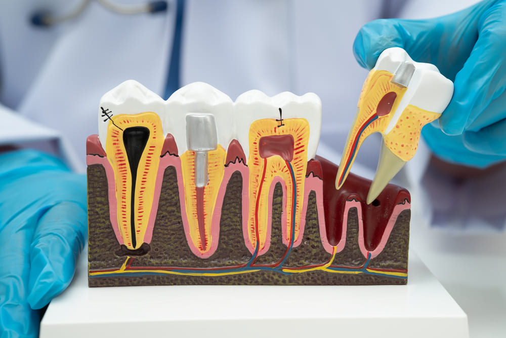 especialistas en endodoncia en Panamá