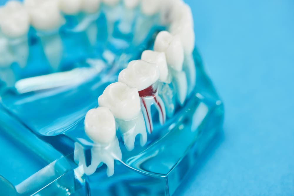 Endodoncia en Panamá: cómo identificar cuándo se necesita